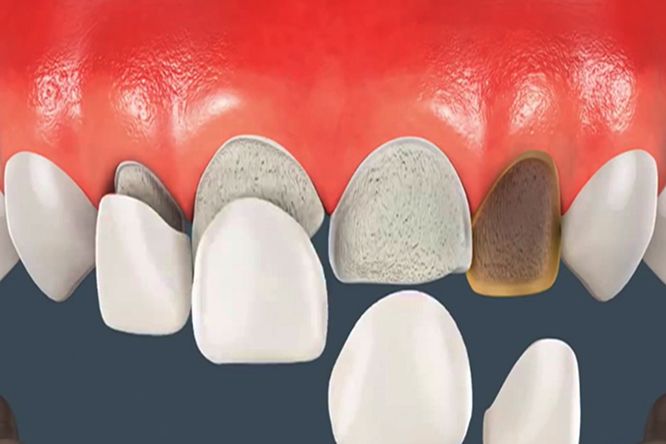 Những trường hợp nên dán sứ Veneer nhung-truong-hop-nen-dan-su-veneer