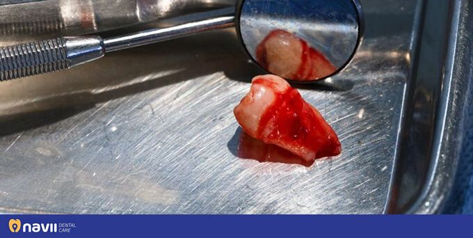 nho-rang-co-bi-giam-tuoi-tho-khong