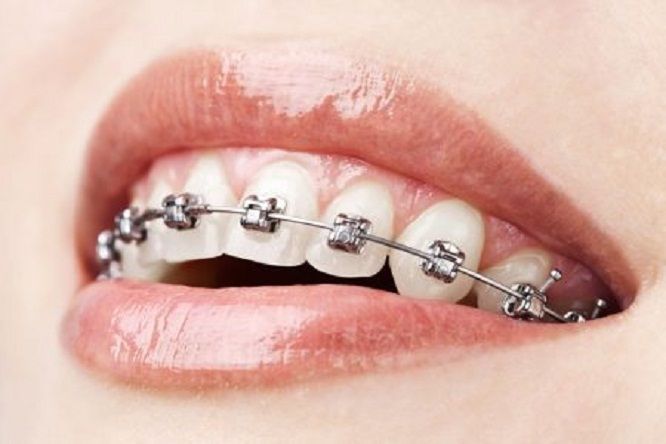 niềng răng có cần nhổ không niềng răng có cần nhổ răng không