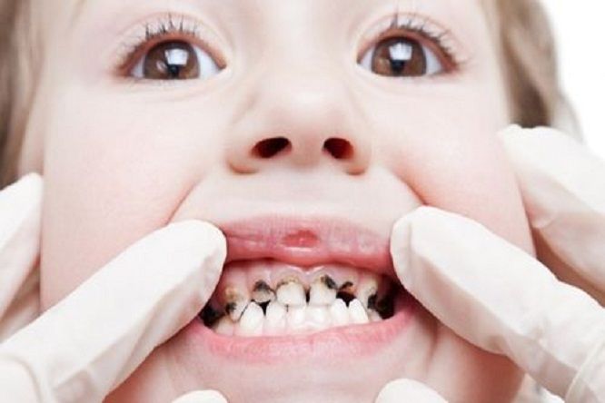 sâu răng trẻ em sâu răng trẻ em