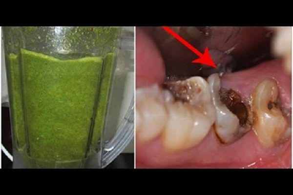 sâu răng trẻ em sâu răng trẻ em