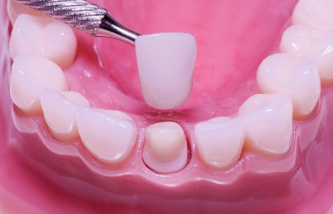 bọc răng sứ hôi miệng bọc răng sứ hôi miệng