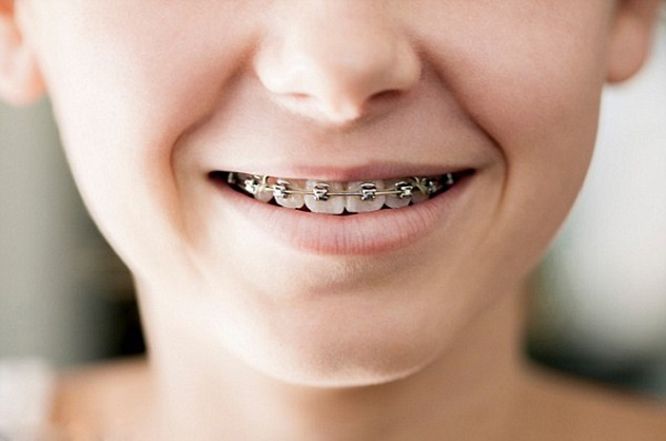 Trẻ mấy tuổi thì nên niềng răng để đạt hiệu quả tốt nhất?