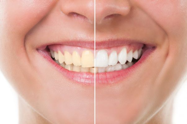 dán sứ veneer có tốt không