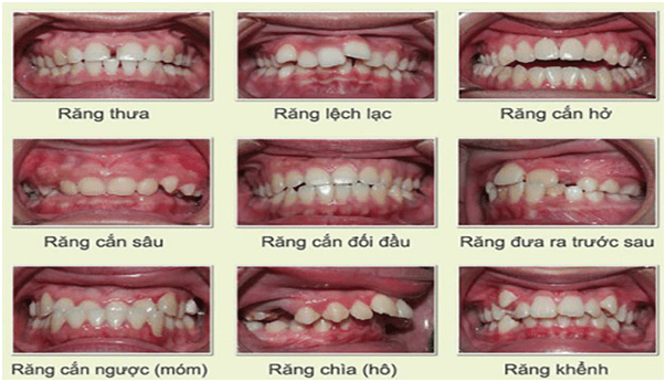 truong-hop-nen-nieng-rang-khong-mac-cai