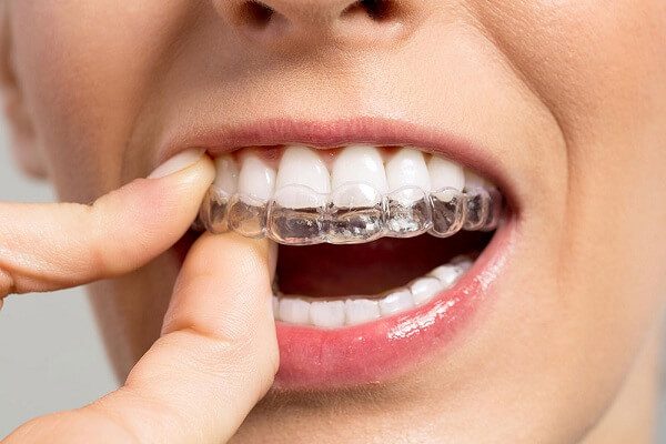 Different types of Orthodontic Braces