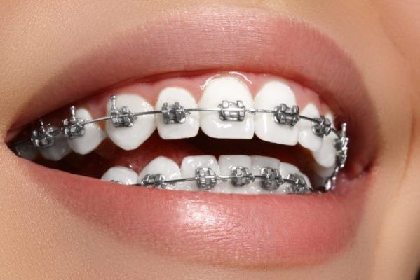 Different types of Orthodontic Braces,