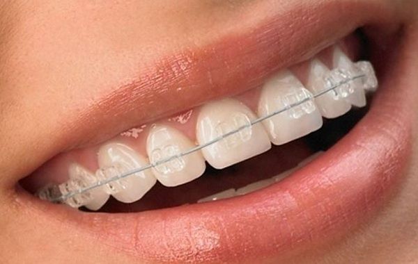 Different types of Orthodontic Braces