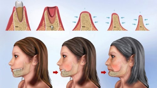 trong-rang-implant-o-dau-tot