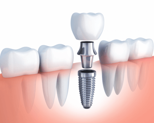 Trồng Răng Giả Implant Bao Nhiêu Tiền