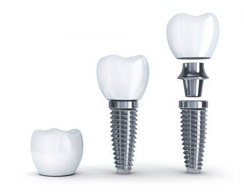 Dental implant