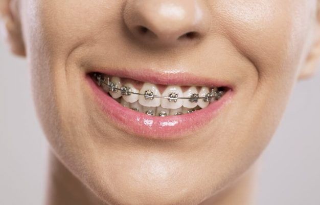 Răng sứ có niềng được không?