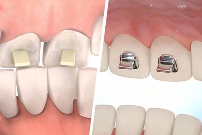 cục_nâng_khớp_cắn