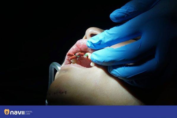 Răng đã lấy tủy bao lâu thì hư? Răng đã lấy tủy bao lâu thì hư?