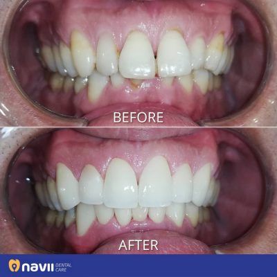 Bọc răng sứ cho răng hô sẽ giúp hàm răng đều đẹp hơn boc-rang-su-cho-rang-ho-tai-nha-khoa-navii