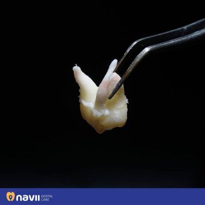 nho-rang-8-nen-kieng-gi