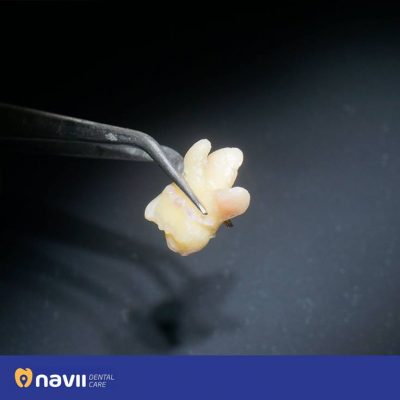 nho-rang-khon-co-dau-khong