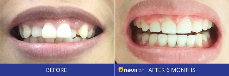 Hiệu quả niềng răng trong suốt 6M tại nha khoa NAvii hieu-qua-truoc-va-sau-khi-nieng-rang-tai-nha-khoa-navii