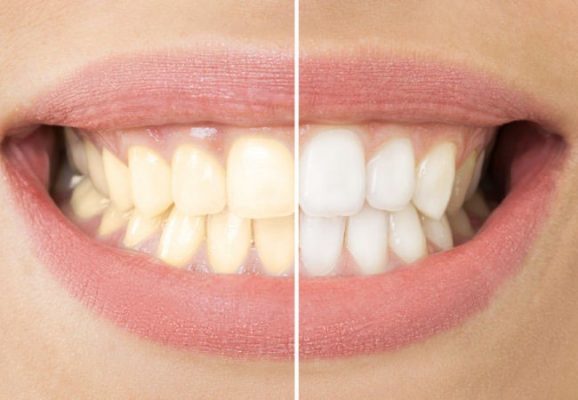 Zoom-teeth-whitening