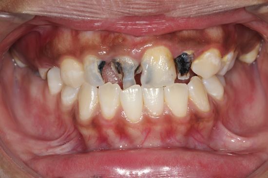 dấu hiệu viêm tủy răng đã bị hoại tử