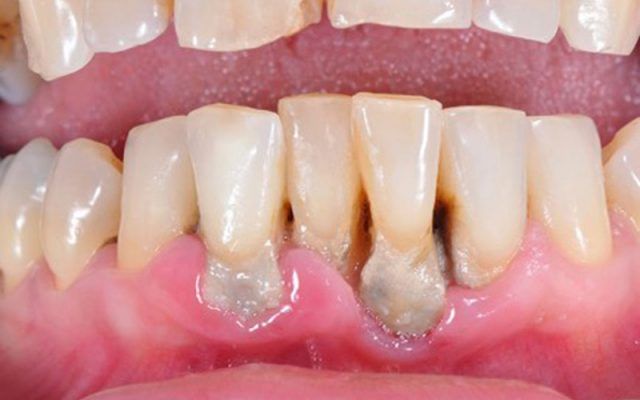 Cao răng phát triển mạnh, lan sâu xuống nướu
