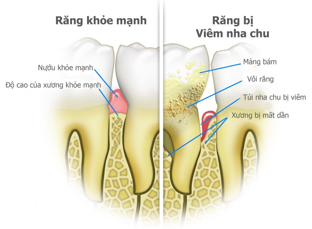 Dấu hiệu bệnh viêm nha chu là gì?