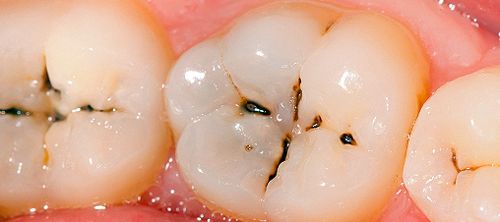 dấu hiệu viêm tủy răng giai đoạn sớm