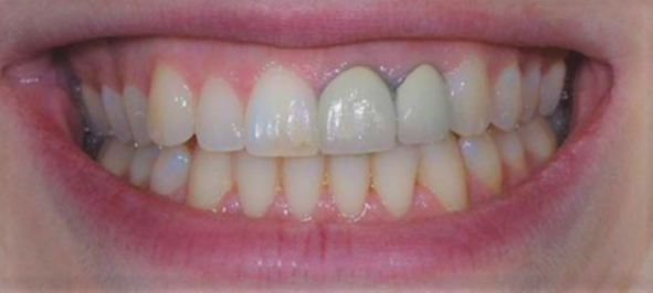 Bọc răng sứ bị hỏng – Khắc phục được không? – Navii Blog