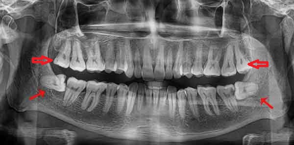 X-Ray of wisdom teeth