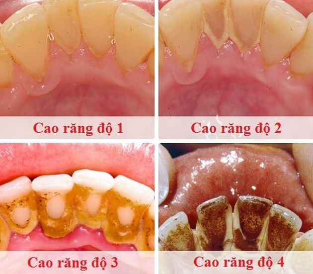 lay-cao-rang-gia-bao-nhieu