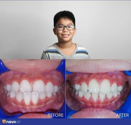 nieng-rang-khong-nho-rang-4