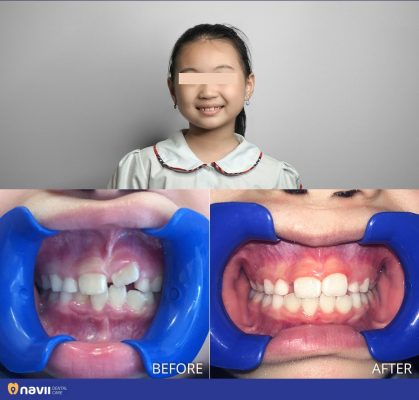 nieng-rang-khong-nho-rang-5