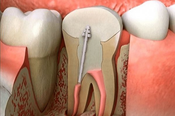 điều trị tủy răng hàm