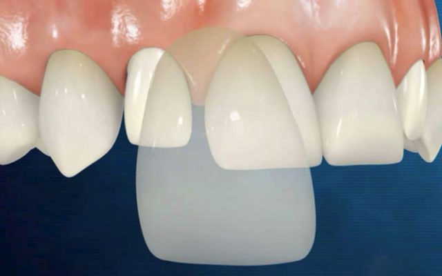 làm răng veneer là gì