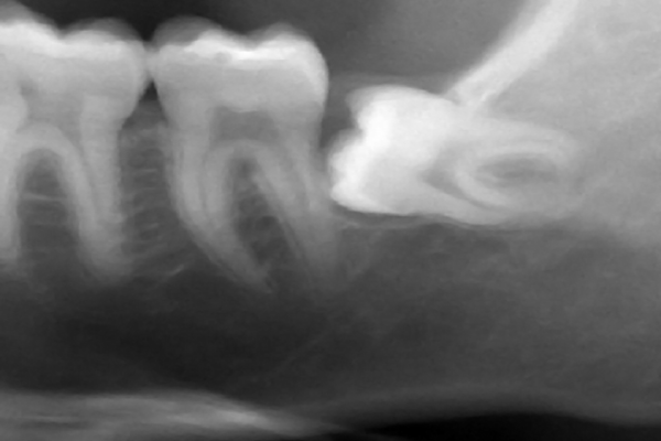 nhổ răng khôn mọc lệch 90 độ