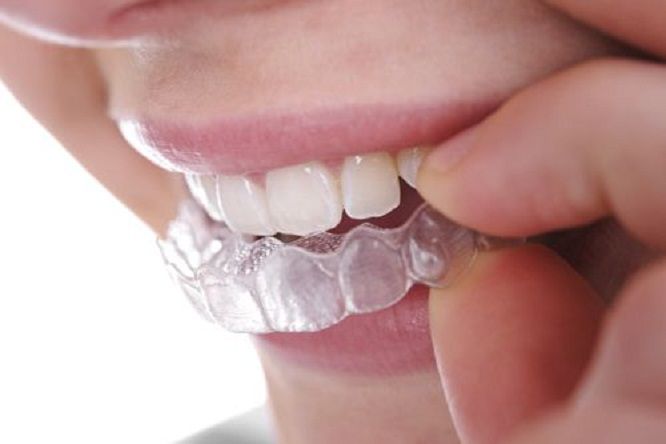 Niềng răng trong suốt Invisalign nieng-rang-trong-suot-invisalign