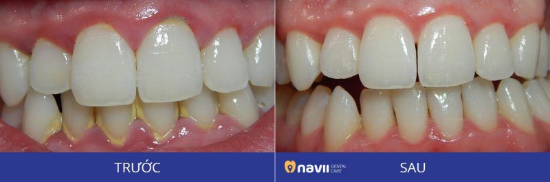 Cạo Vôi Răng Có Đau Không?