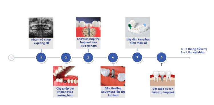 Quy trình trồng răng, cấy ghép Implant tại nha khoa Navii quy-trinh-cay-ghep-implant-tai-nha-khoa-navii