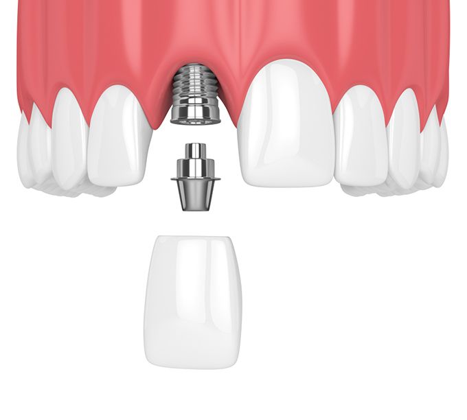 Trồng răng, cấy ghép Implant là giải pháp thay thế hoàn hảo trong-rang-cay-ghep-implant