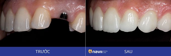 truoc-va-sau-cam-implant