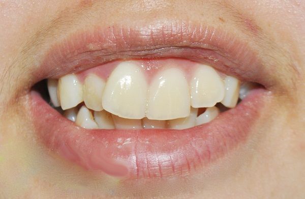 Bọc răng sứ cho răng hô