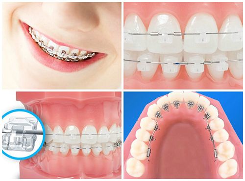 Các loại mắc cài niềng răng sẽ góp phần ảnh hưởng thời gian niềng răng