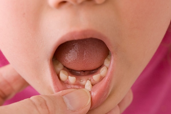 Nhổ răng sữa cho trẻ và những sai lầm phụ huynh nào cũng mắc phải – Navii  Blog