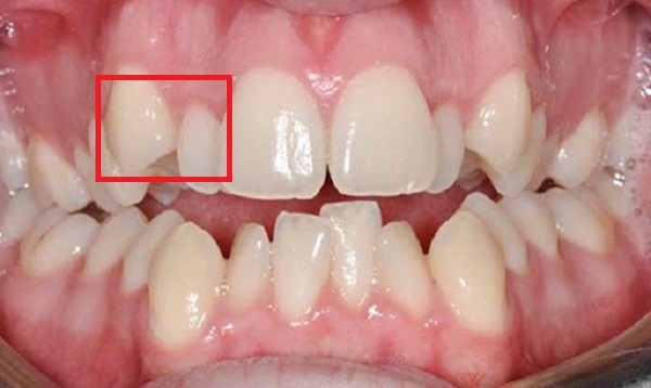 Răng lồi xỉ là răng gì và cần phải xử lý chúng ra sao? – Navii Blog