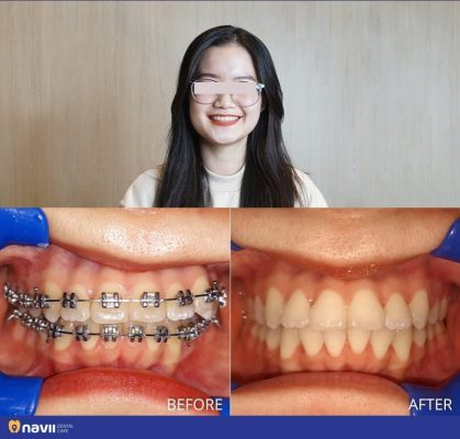 bang-gia-nieng-rang-khong-mac-cai-invisalign-ha-noi