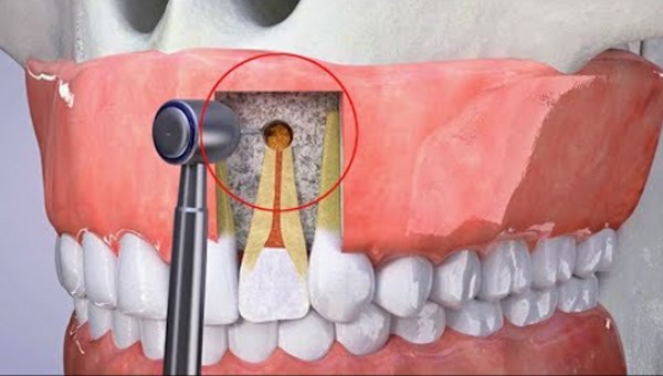 Cắt chóp răng bao nhiêu tiền? Phẫu thuật cắt chóp răng có nguy hiểm không?  – Navii Blog