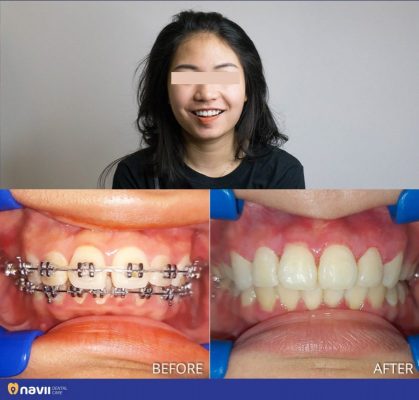 nieng-rang-tra-gop-ha-noi